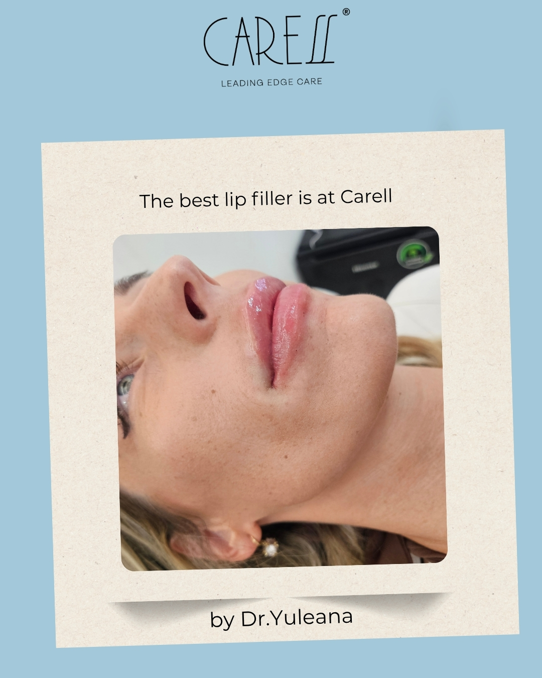 Relleno de Labios en Mérida: Diseño de Labios Premium con la Dra. Yuleana Cabral