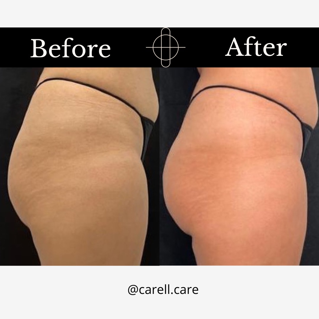 Butt Lift sin cirugía: Levantamiento de Glúteos con Radiesse®